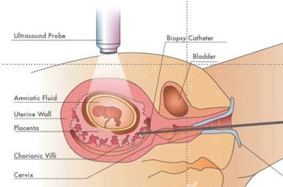 绒毛穿刺手术过程（做绒毛穿刺的手术视频）-图2