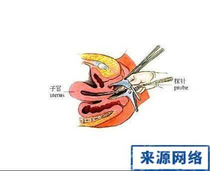 女孩子带避孕环过程（女孩子带避孕环过程图片大全）-图2