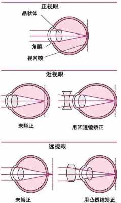 光进去眼睛的过程（光进入眼睛后在哪里成像）-图2