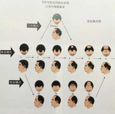 秃头的过程（秃头的概念）-图3