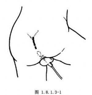 屁眼扩张过程（屁眼扩张过程图片）-图2