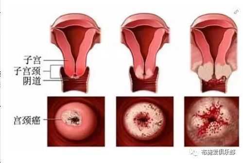 妇科蔓延过程图（妇科咋了）-图3