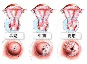 妇科蔓延过程图（妇科咋了）-图2