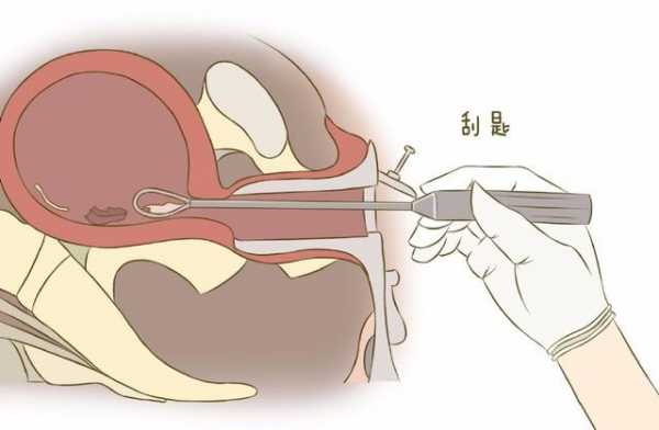 清宫是怎样的过程图解（清宫具体是怎么操作）-图2