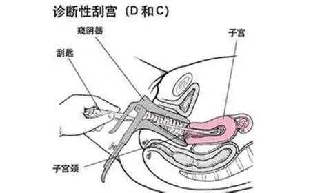 清宫是怎样的过程图解（清宫具体是怎么操作）-图3