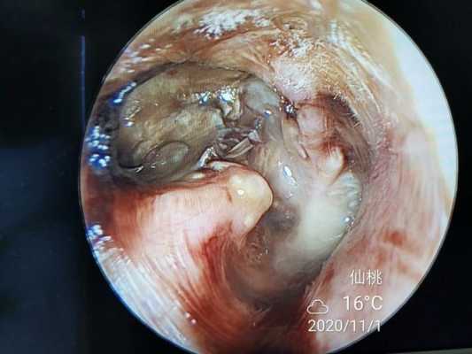 胆脂瘤中耳炎手术过程（胆脂瘤中耳炎手术过程图解）-图1