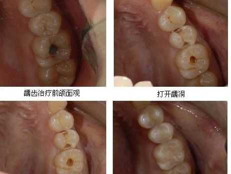 牙齿补牙过程（牙齿补牙过程大概要治疗多久才能好）-图2