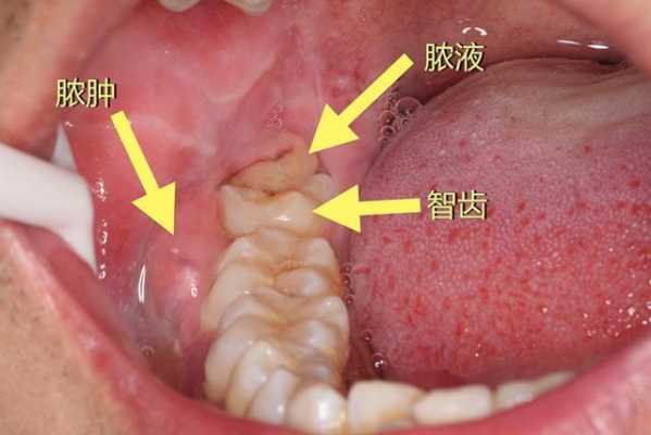 术后炎症过程（术后炎症过程图解）-图2