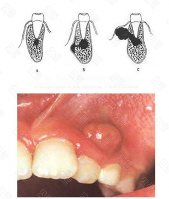 根尖炎发展过程（根尖炎的形成）-图3