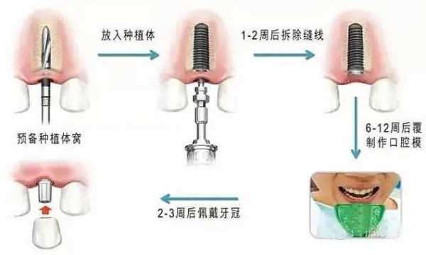 种植牙治疗过程（种植牙治疗过程视频）-图1