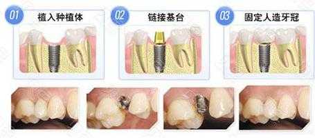 种植牙治疗过程（种植牙治疗过程视频）-图3