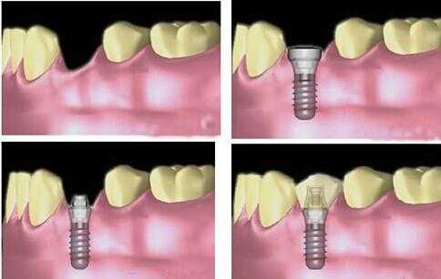 种植牙治疗过程（种植牙治疗过程视频）-图2