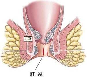 肛裂痒愈合过程（肛裂后痒是愈合么）-图1