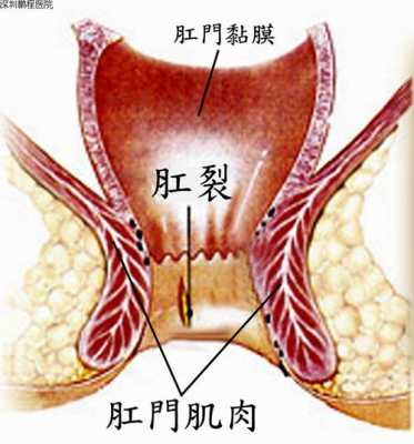 肛裂痒愈合过程（肛裂后痒是愈合么）-图3