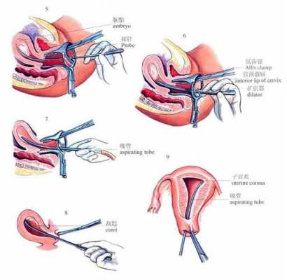 刮宫视频过程（刮宫视频手术过程高清）-图3