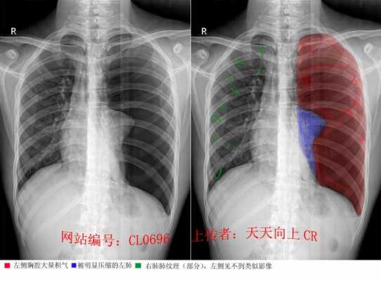 气胸飞机加压过程（气胸 飞机）-图2