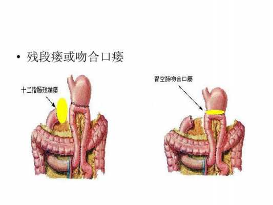 吻合口生长过程（吻合口生长过程图片）-图1