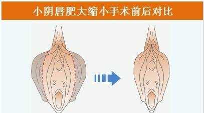 妇科整形过程图片（妇科整形前后对比图片）-图1