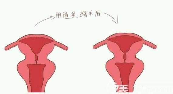 妇科整形过程图片（妇科整形前后对比图片）-图2