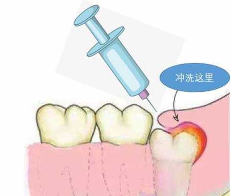 冠周炎冲洗过程（冠周炎冲洗是怎么洗的）-图1